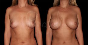 before and after breast augmentation front view female patient case 1155