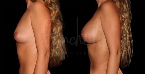 before and after breast augmentation side view female patient case 1159