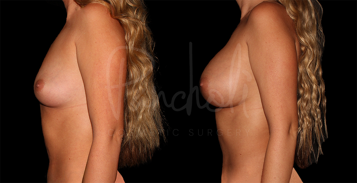 before and after breast augmentation side view female patient case 1159