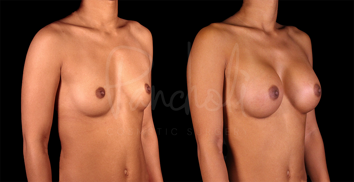 before and after breast augmentation front angle view female patient case 1159