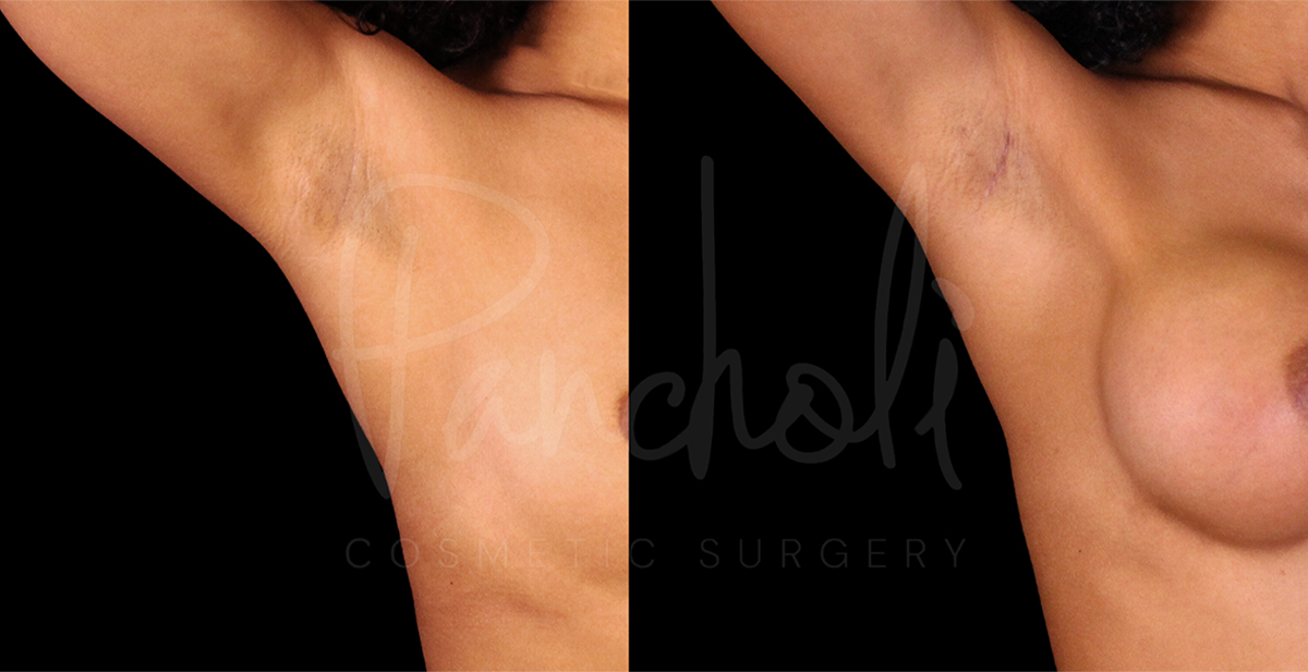 before and after breast augmentation front view close up female patient case 1159