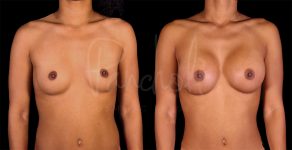 before and after breast augmentation front view female patient case 1159
