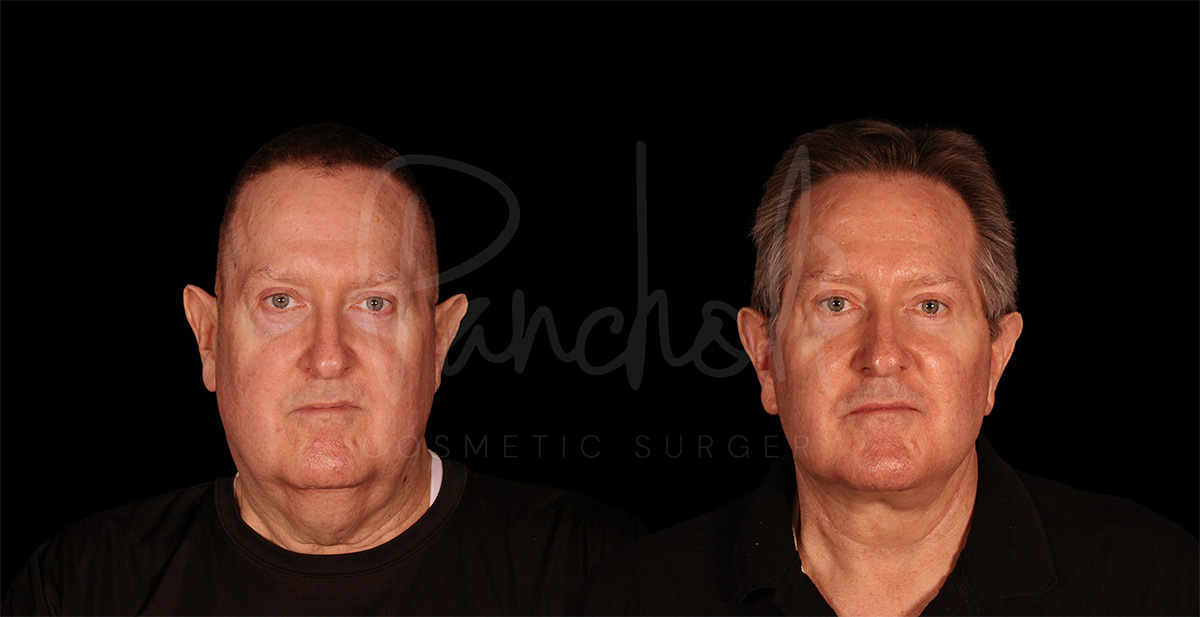 before and after male facelift front side view case 1176