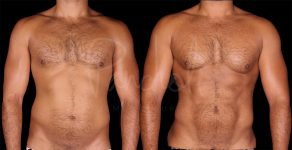 before and after vaser liposuction front view male patient case 1172
