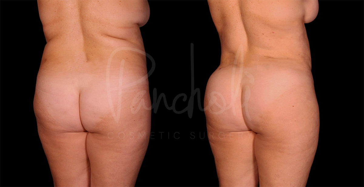 before and after liposuction female patient back angle view case 1495