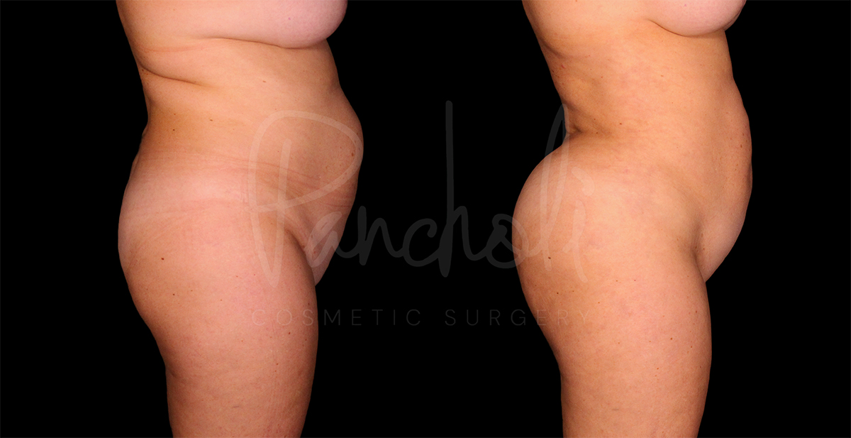 before and after liposuction female patient side view case 1495