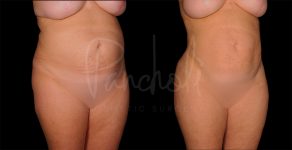 before and after liposuction female patient front angle view case 1495