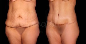 before and after Belt Lipectomy angle view female patient case 1852