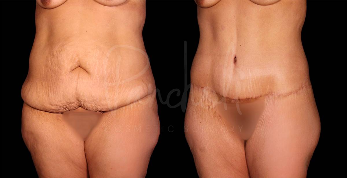 before and after Belt Lipectomy angle view female patient case 1852