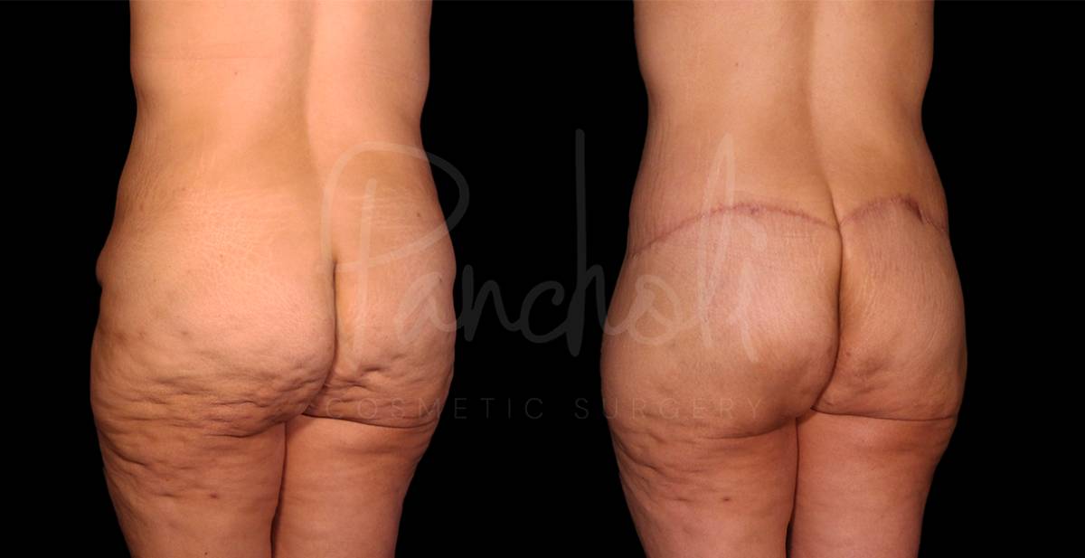 before and after Belt Lipectomy back angle view female patient case 1852