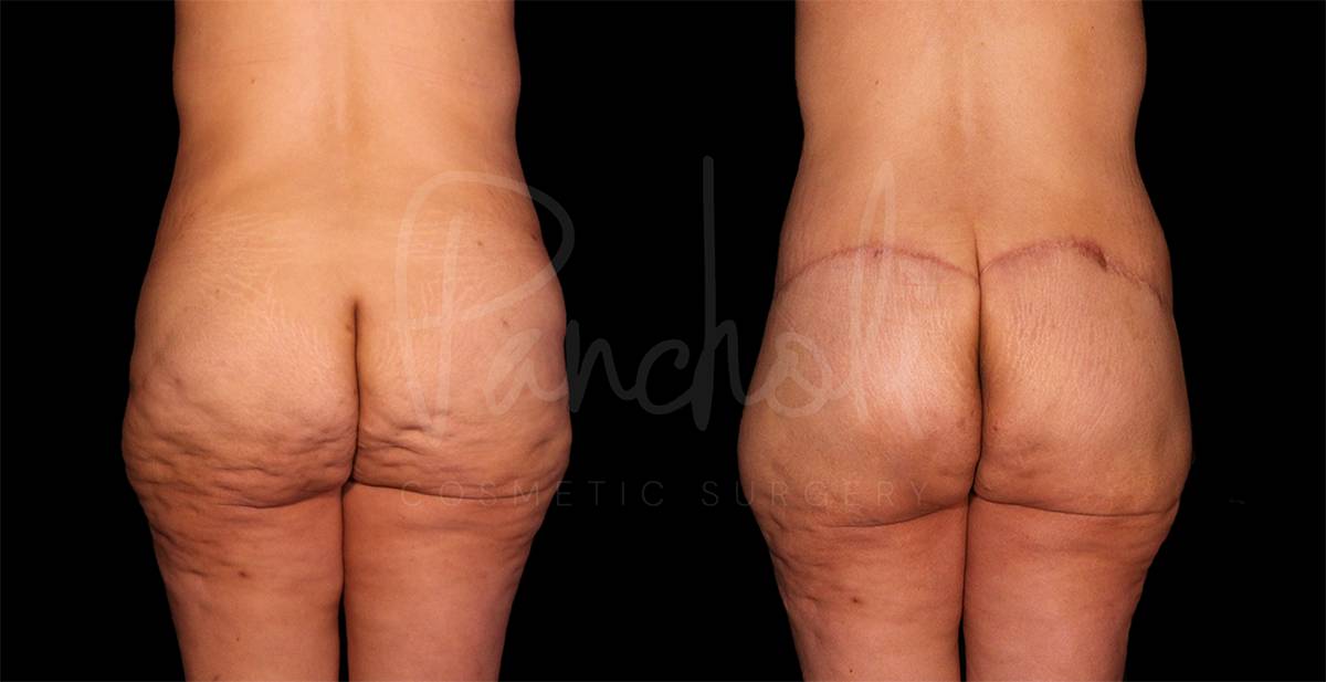 before and after Belt Lipectomy back view female patient case 1852