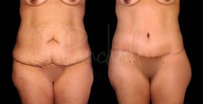 before and after Belt Lipectomy front view female patient case 1852