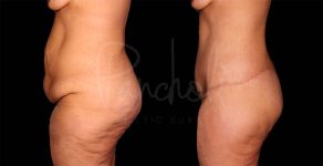 before and after Belt Lipectomy side view female patient case 1852