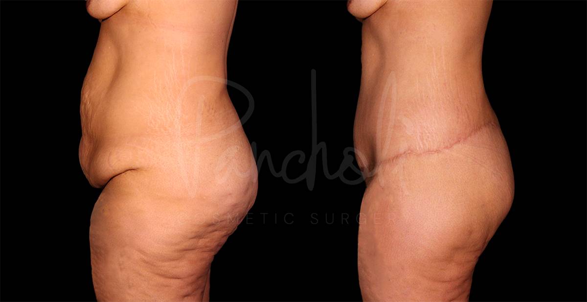 before and after Belt Lipectomy side view female patient case 1852