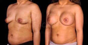 before and after breast augmentation angle view female patient case 1858