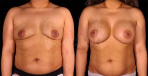 before and after breast augmentation front view female patient case 1858