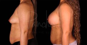 before and after breast augmentation side view female patient case 1858