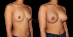 before and after breast augmentation angle view female patient case 1862