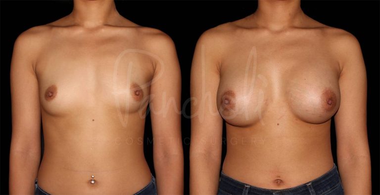 before and after breast augmentation front view female patient case 1862