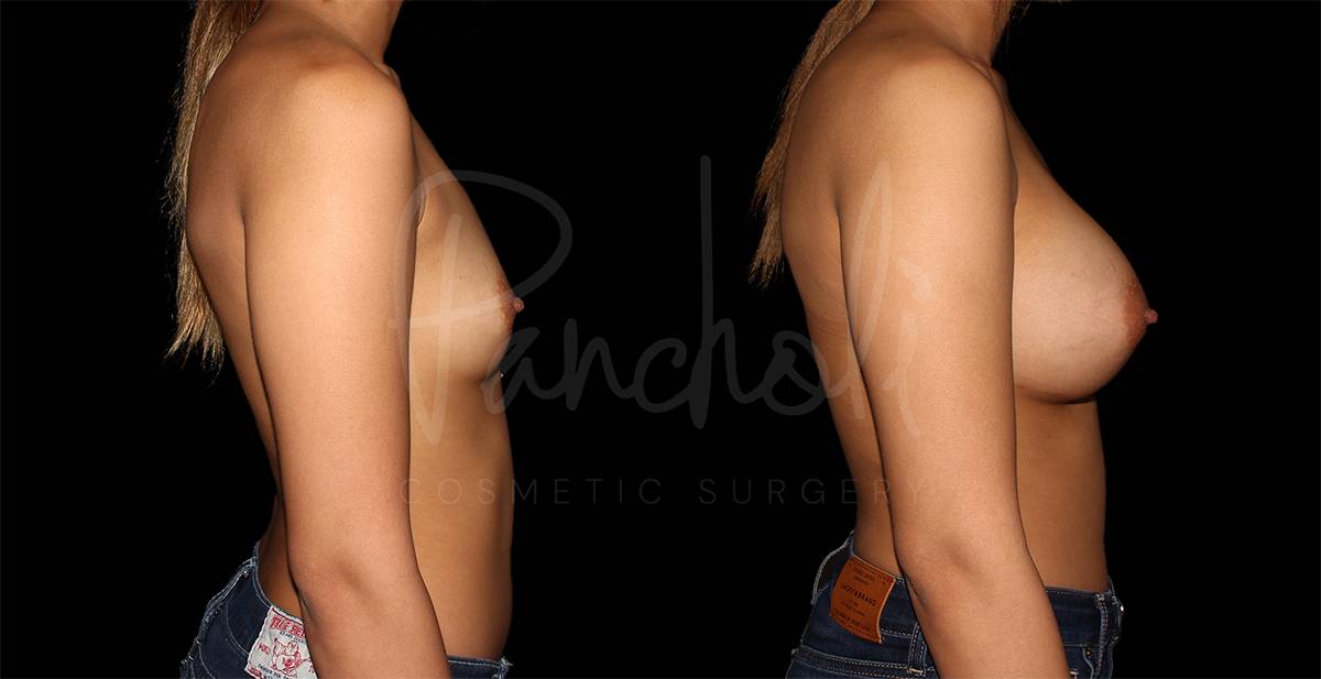 before and after breast augmentation side view female patient case 1862
