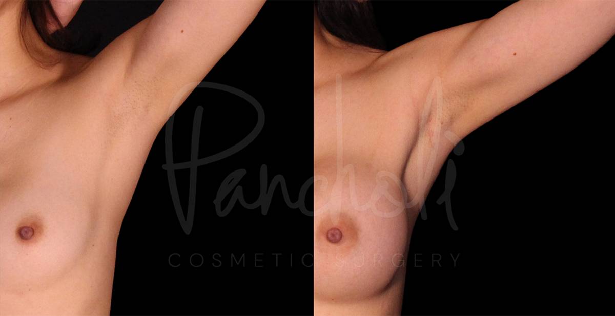 before and after breast augmentation front close up view case 2037