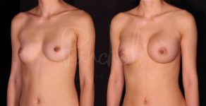 before and after breast augmentation left angle view case 2037