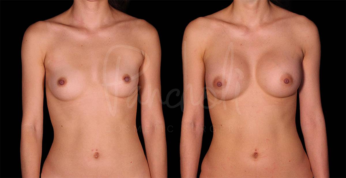 before and after breast augmentation front view case 2037