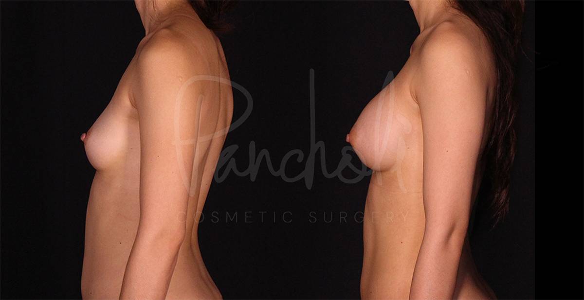 before and after breast augmentation left view case 2037