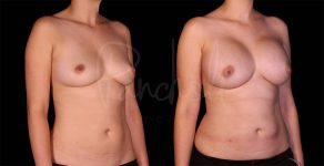 before and after breast augmentation right angle view case 3041