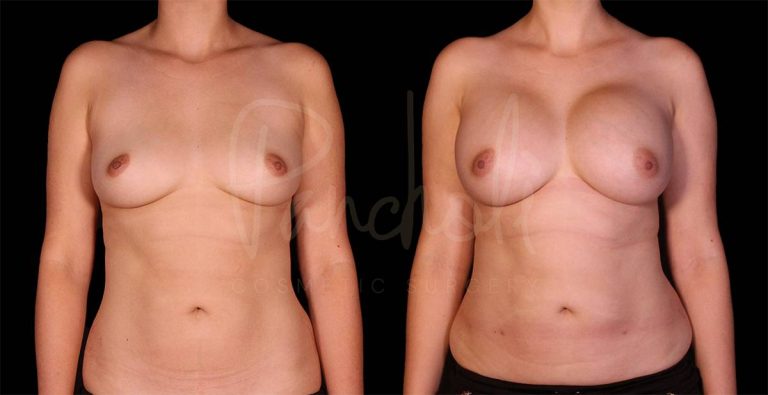 before and after breast augmentation front view case 3041