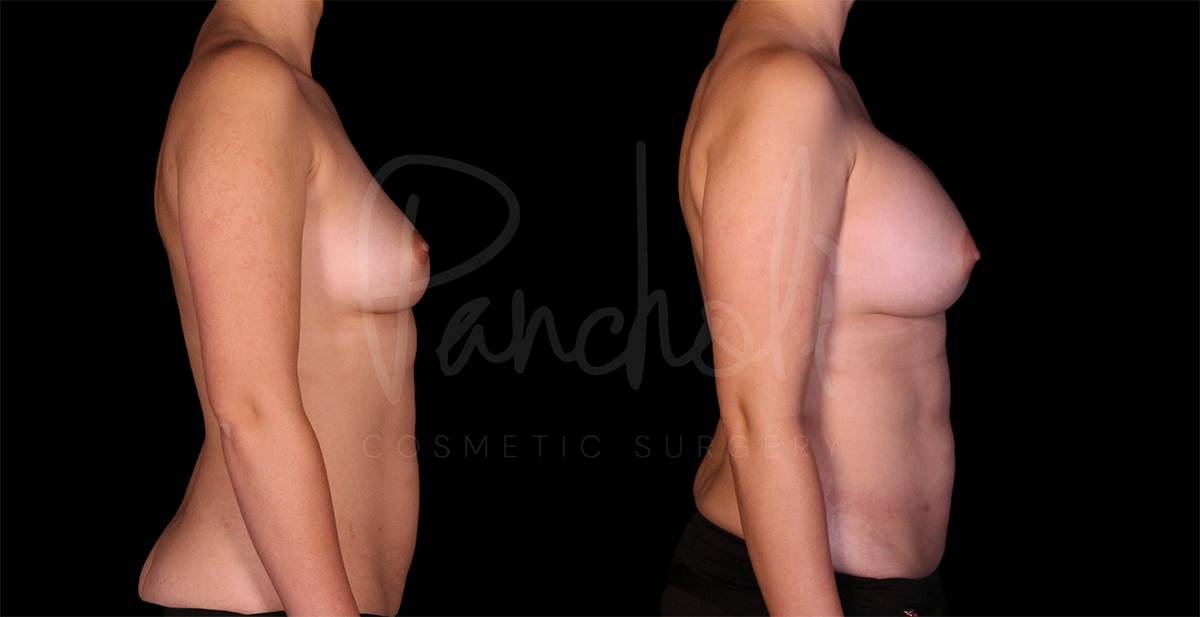 before and after breast augmentation angle view case 3041