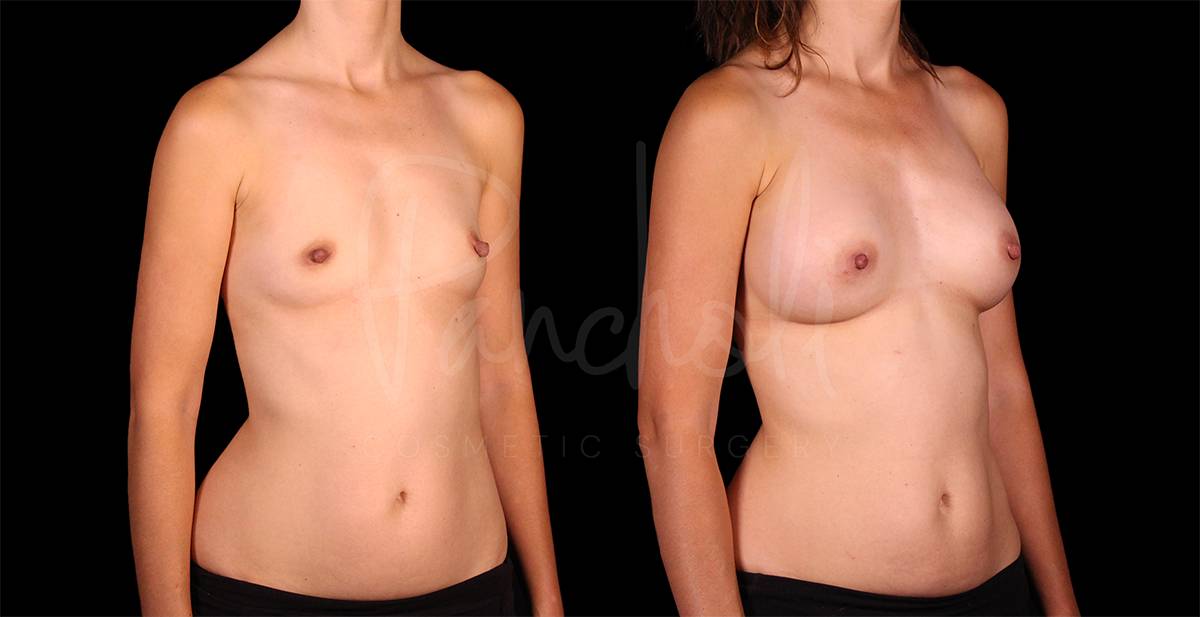 before and after breast augmentation right angle view case 3052