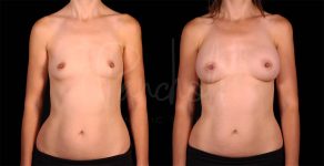 before and after breast augmentation front view case 3052