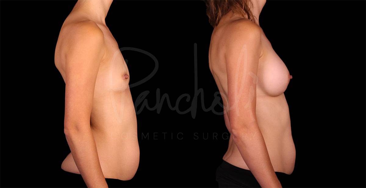 before and after breast augmentation side view case 3052