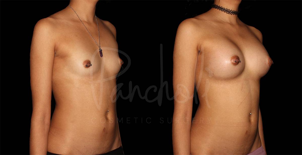 before and after breast augmentation angle view case 3060