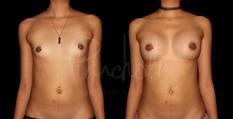 before and after breast augmentation front view case 3060