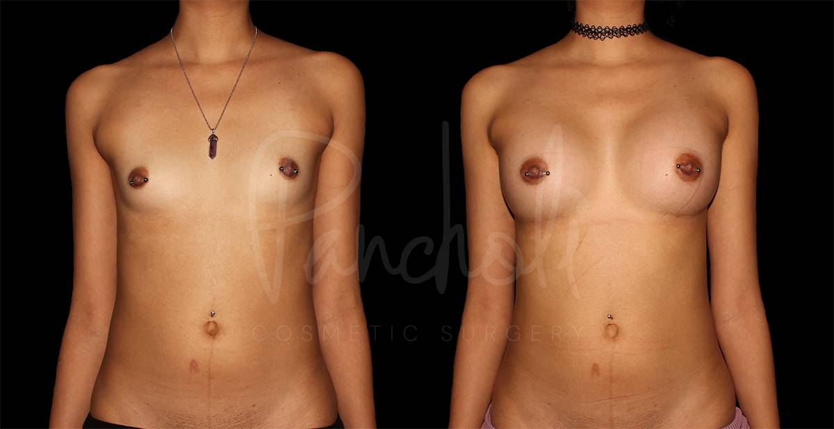 before and after breast augmentation front view case 3060