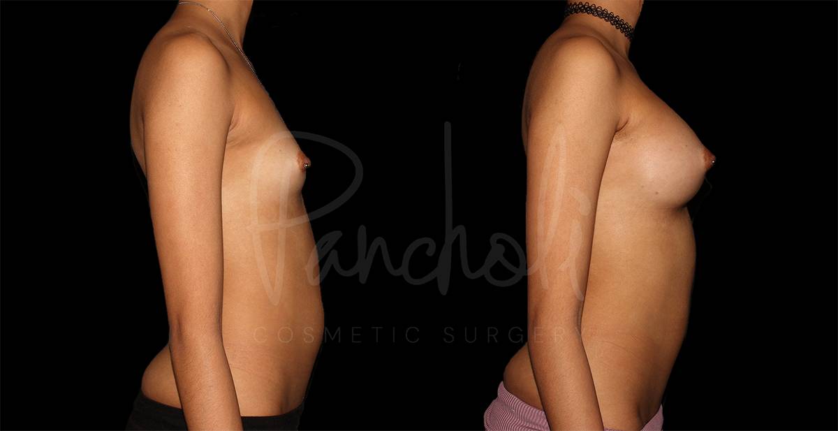 before and after breast augmentation side view case 3060