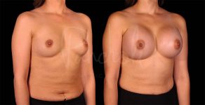 before and after breast augmentation angle view case 3069