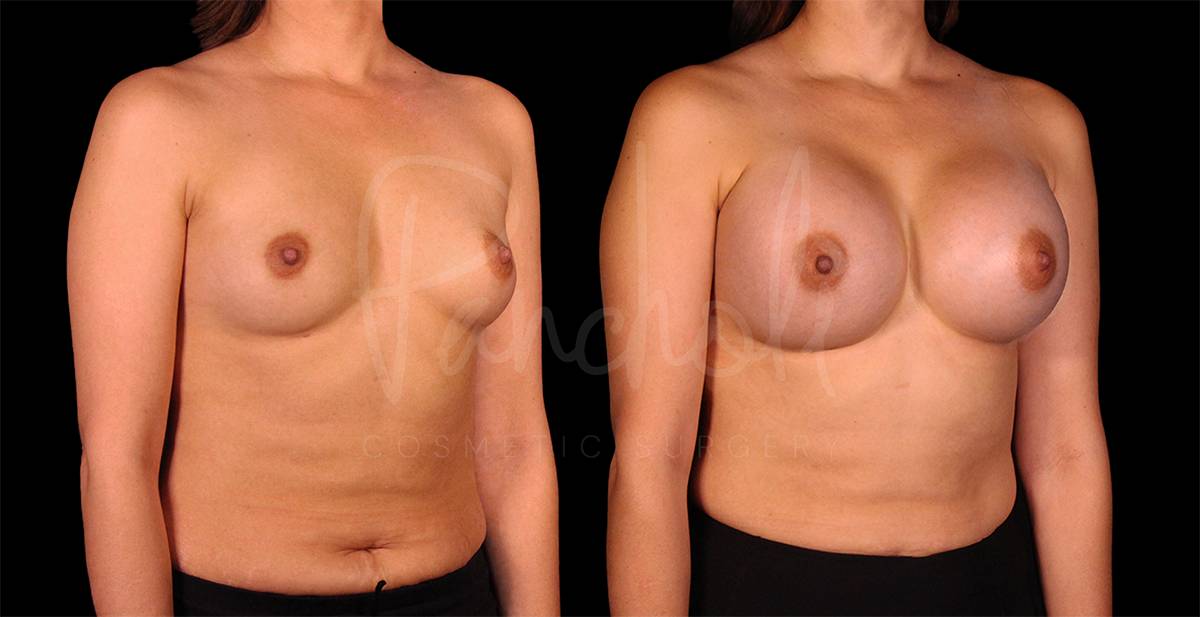 before and after breast augmentation angle view case 3069