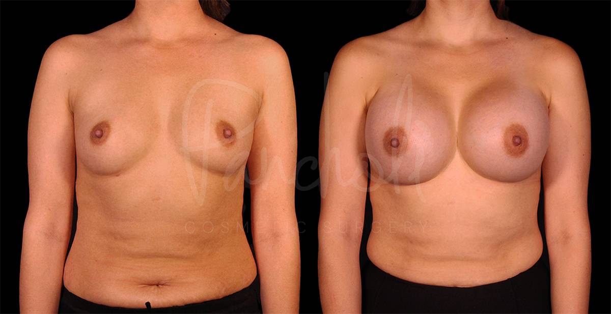 before and after breast augmentation front view case 3069