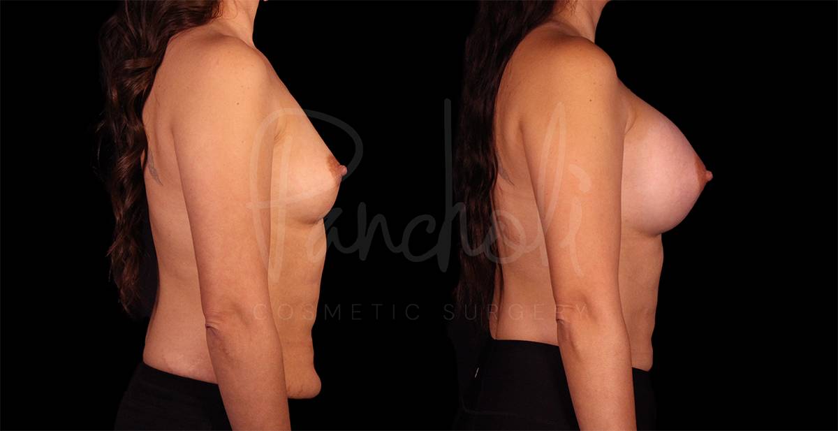before and after breast augmentation side view case 3069