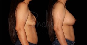 before and after breast implant replacement side view female patient case 1872