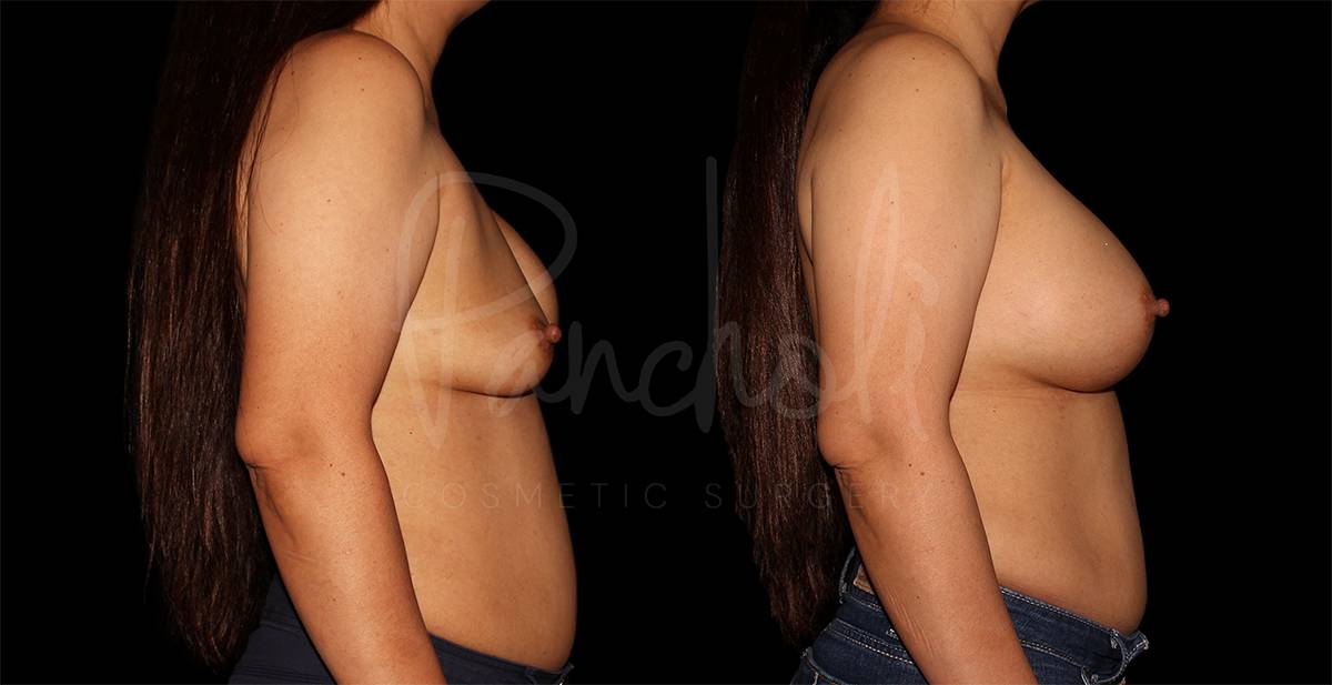 before and after breast implant replacement side view female patient case 1872