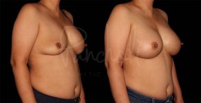 before and after breast implant replacement angle view female patient case 1872