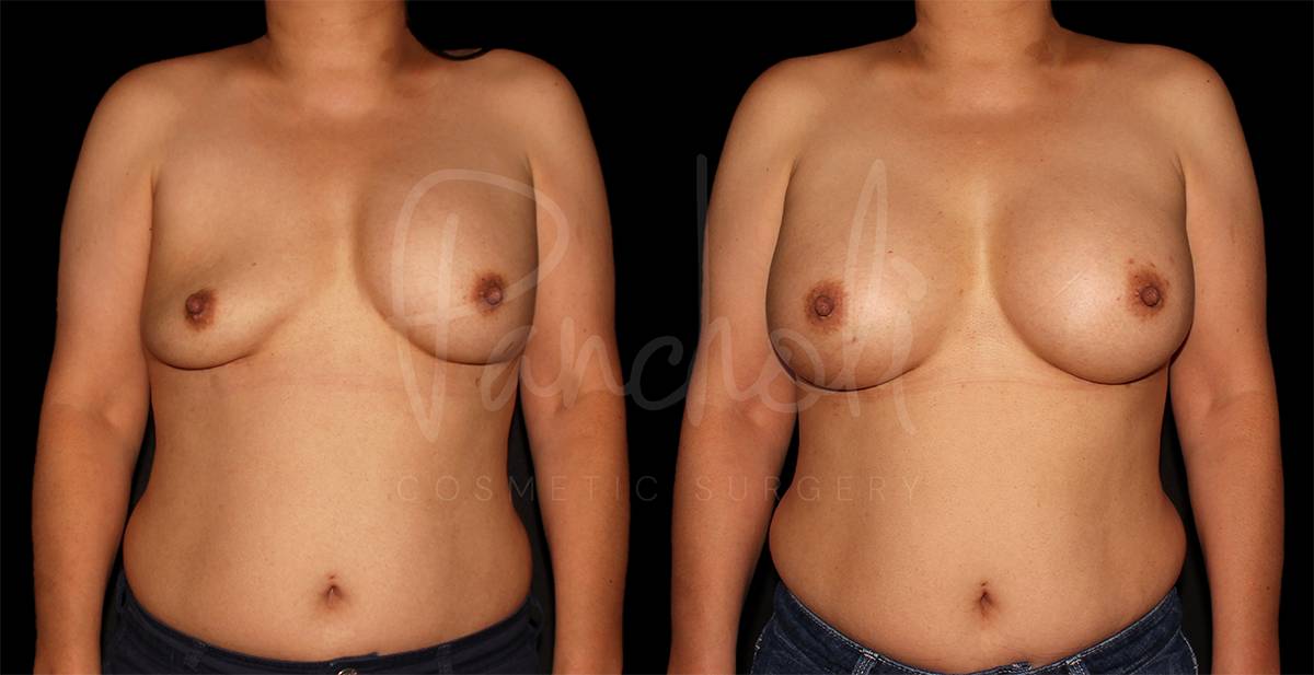 before and after breast implant replacement front view female patient case 1872