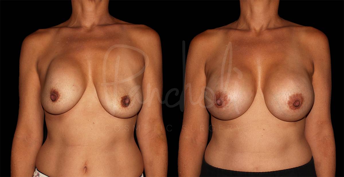 before and after breast implant replacement front view case 3023