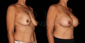 before and after breast implant replacement right anlge view case 3023