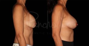 before and after breast implant replacement right side view case 3023