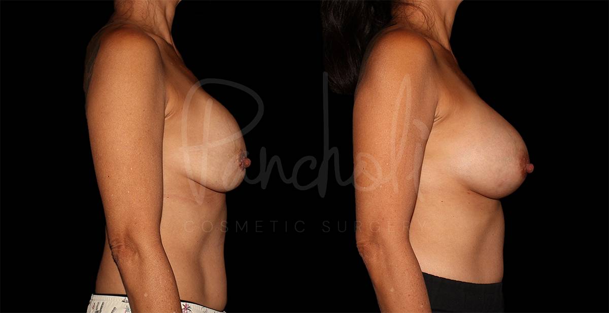 before and after breast implant replacement right side view case 3023